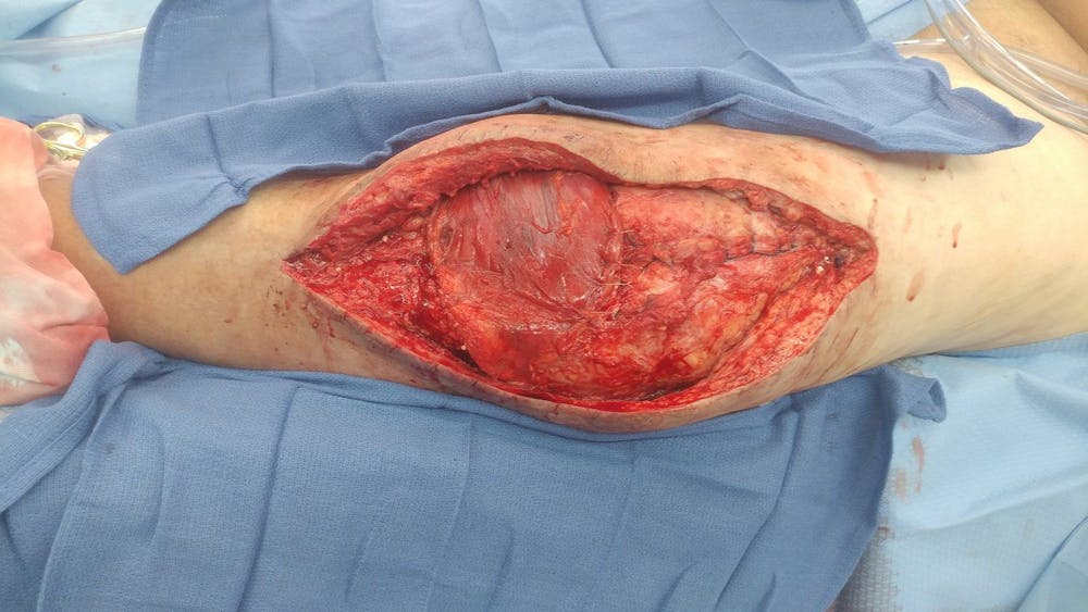 Extremity Reconstruction Before & After Gallery - Patient 5799950 - Image 2