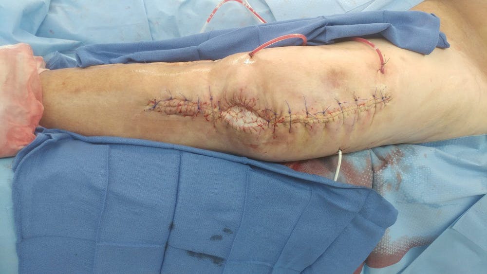 Extremity Reconstruction Before & After Gallery - Patient 5799950 - Image 3
