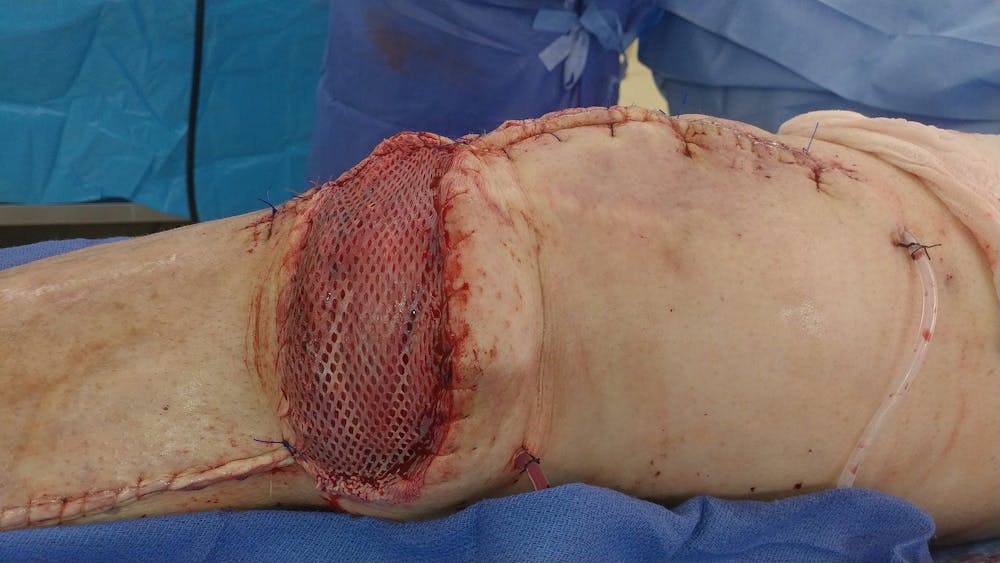 Extremity Reconstruction Before & After Gallery - Patient 5799952 - Image 2