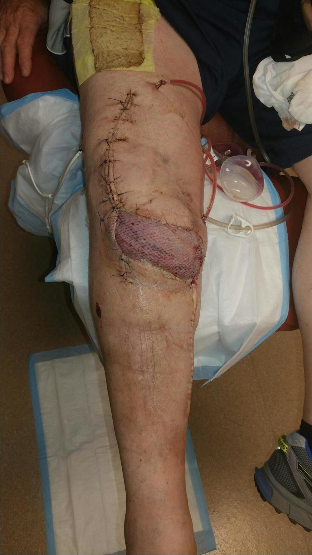 Extremity Reconstruction Before & After Gallery - Patient 5799952 - Image 3