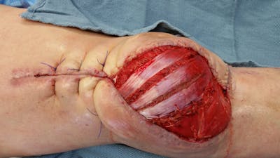 Extremity Reconstruction Before & After Gallery - Patient 5799974 - Image 1