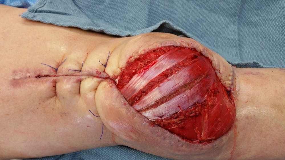 Extremity Reconstruction Before & After Gallery - Patient 5799974 - Image 1