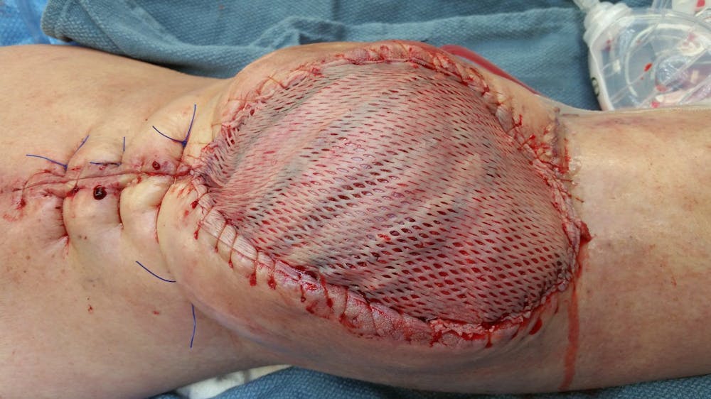 Extremity Reconstruction Before & After Gallery - Patient 5799974 - Image 2