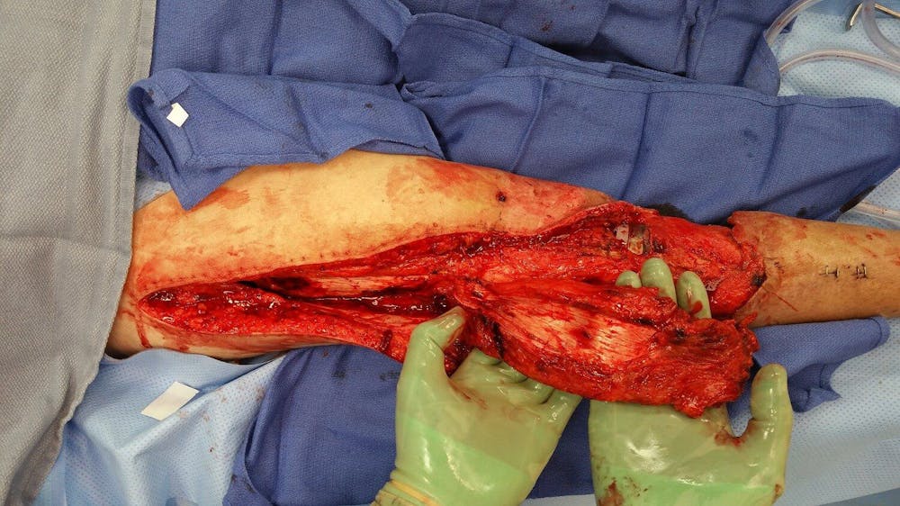 Extremity Reconstruction Before & After Gallery - Patient 5799977 - Image 1