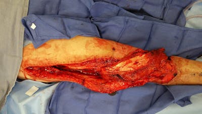 Extremity Reconstruction Before & After Gallery - Patient 5799977 - Image 2
