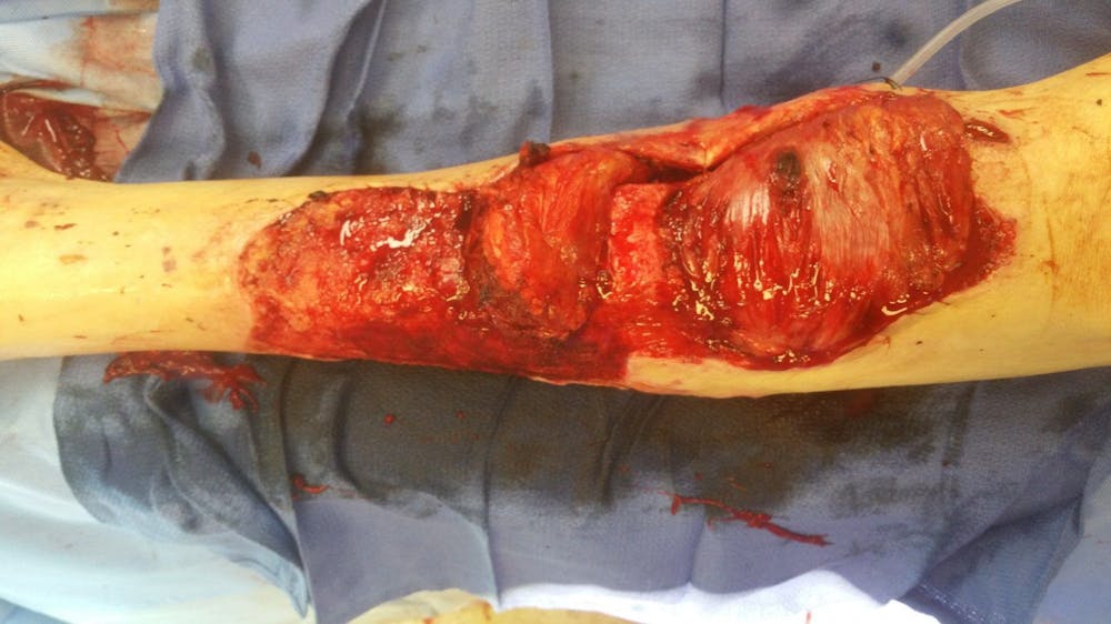 Extremity Reconstruction Before & After Gallery - Patient 5799978 - Image 1