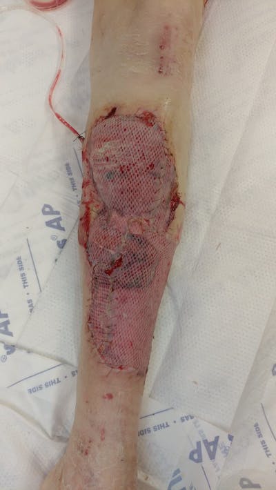 Extremity Reconstruction Before & After Gallery - Patient 5799978 - Image 2