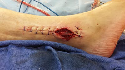 Extremity Reconstruction Before & After Gallery - Patient 5799980 - Image 2