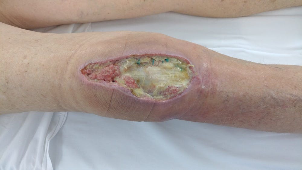 Extremity Reconstruction Before & After Gallery - Patient 5800002 - Image 1