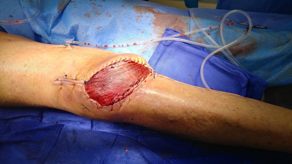 Extremity Reconstruction Before & After Gallery - Patient 5800002 - Image 2