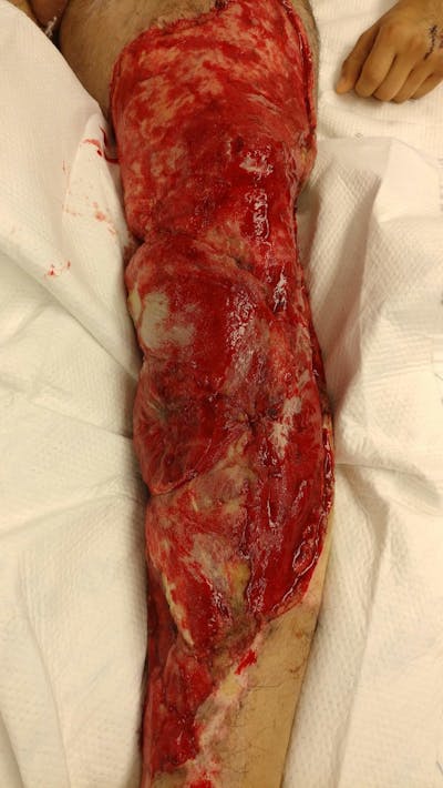 Extremity Reconstruction Before & After Gallery - Patient 5800003 - Image 1