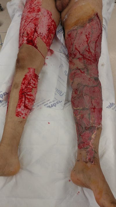 Extremity Reconstruction Before & After Gallery - Patient 5800003 - Image 2