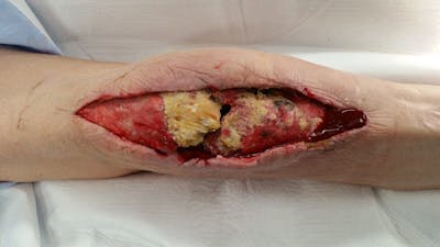 Extremity Reconstruction Before & After Gallery - Patient 5800005 - Image 1