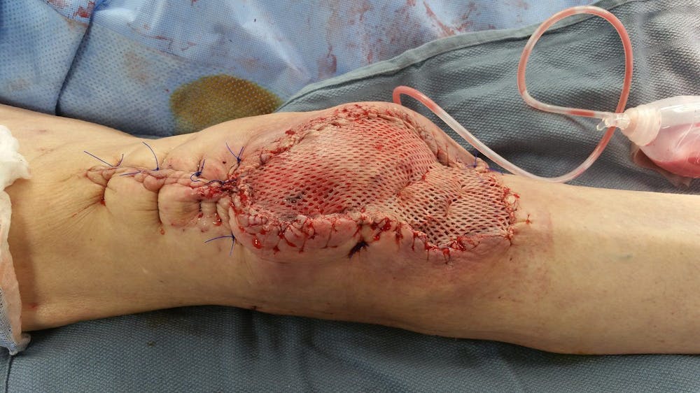 Extremity Reconstruction Before & After Gallery - Patient 5800005 - Image 2