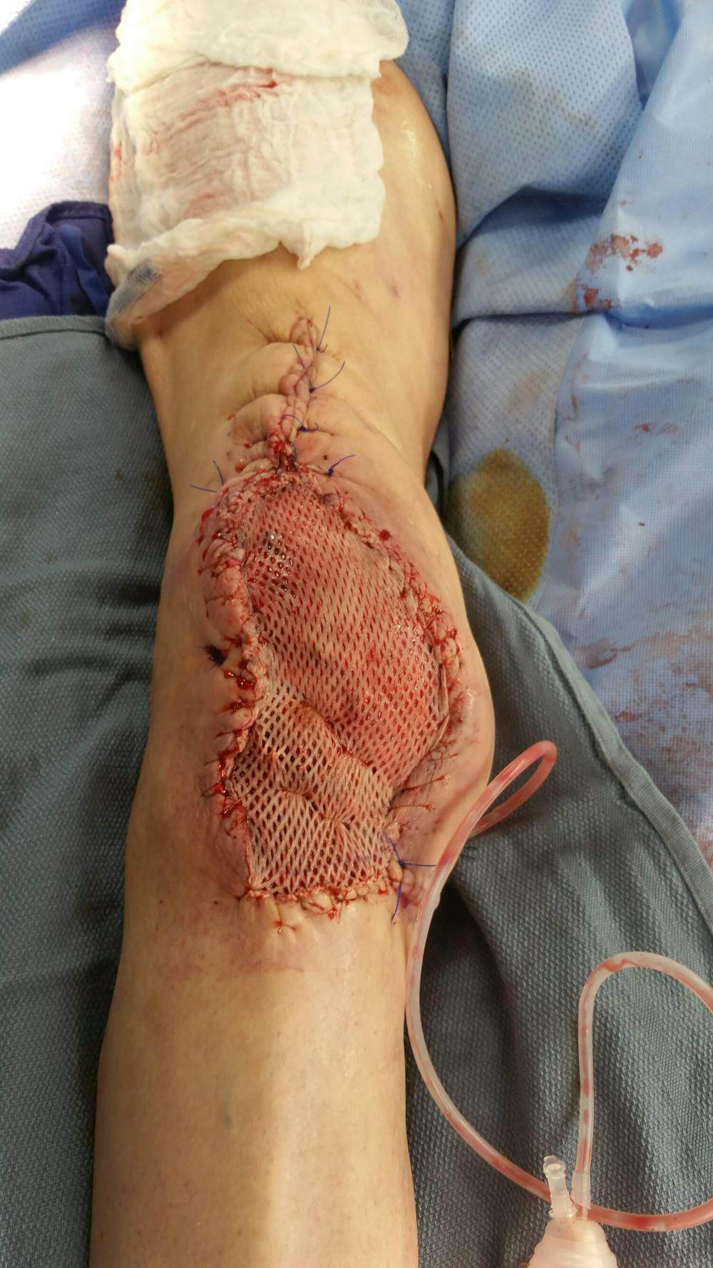 Extremity Reconstruction Before & After Gallery - Patient 5800005 - Image 3
