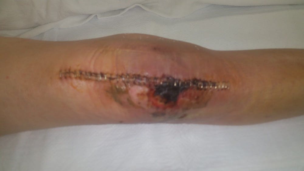 Extremity Reconstruction Before & After Gallery - Patient 5800008 - Image 3