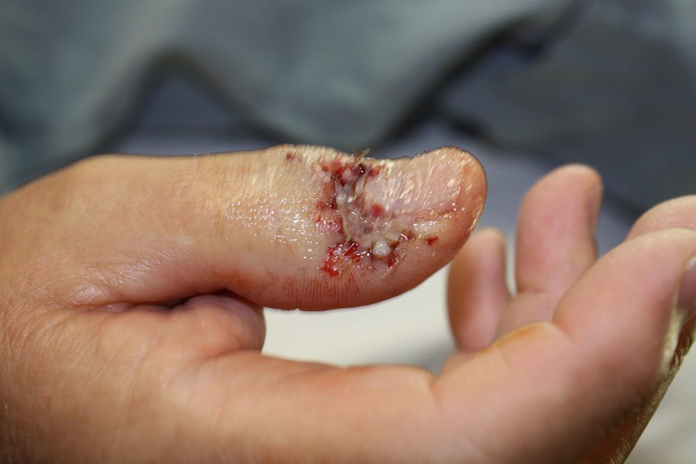 Extremity Reconstruction Before & After Gallery - Patient 5800009 - Image 3