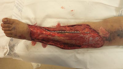 Extremity Reconstruction Before & After Gallery - Patient 5800011 - Image 1