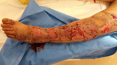 Extremity Reconstruction Before & After Gallery - Patient 5800011 - Image 2
