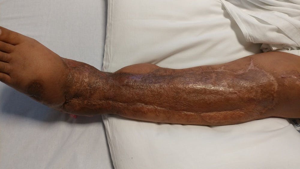 Extremity Reconstruction Before & After Gallery - Patient 5800011 - Image 3