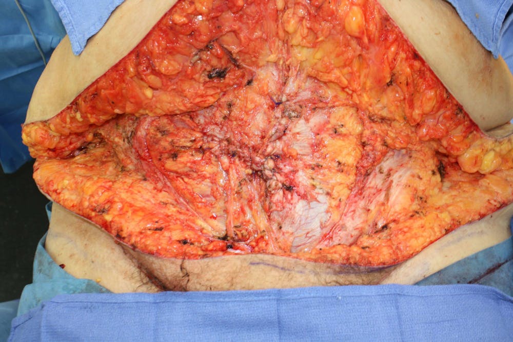 Large Ventral Hernia Repair Before & After Gallery - Patient 5800012 - Image 2