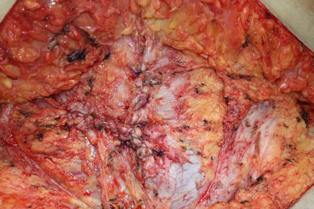 Large Ventral Hernia Repair Before & After Gallery - Patient 5800012 - Image 3