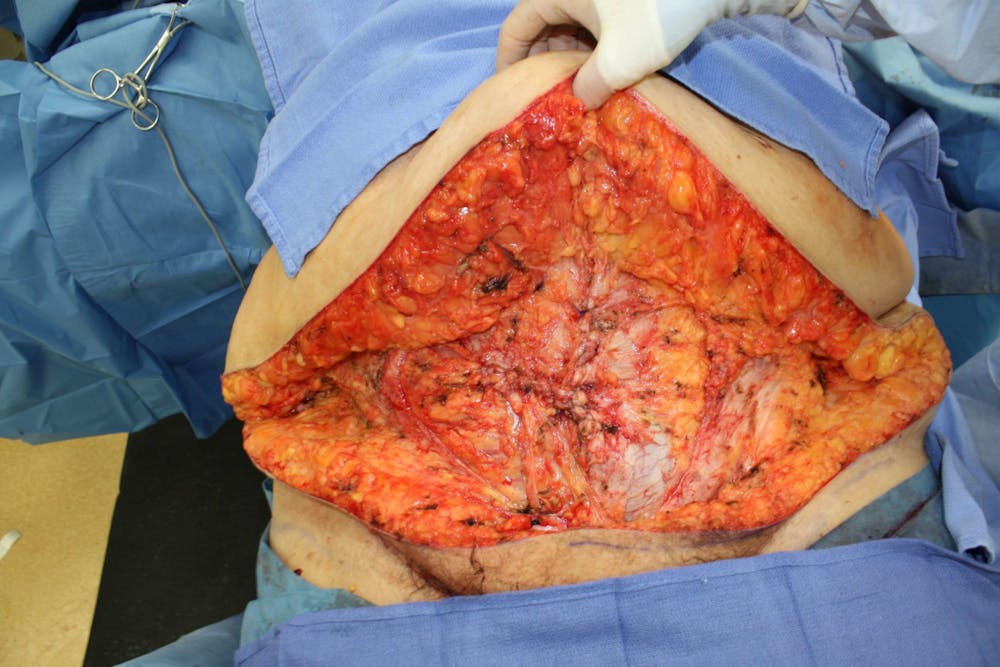 Large Ventral Hernia Repair Before & After Gallery - Patient 5800012 - Image 4