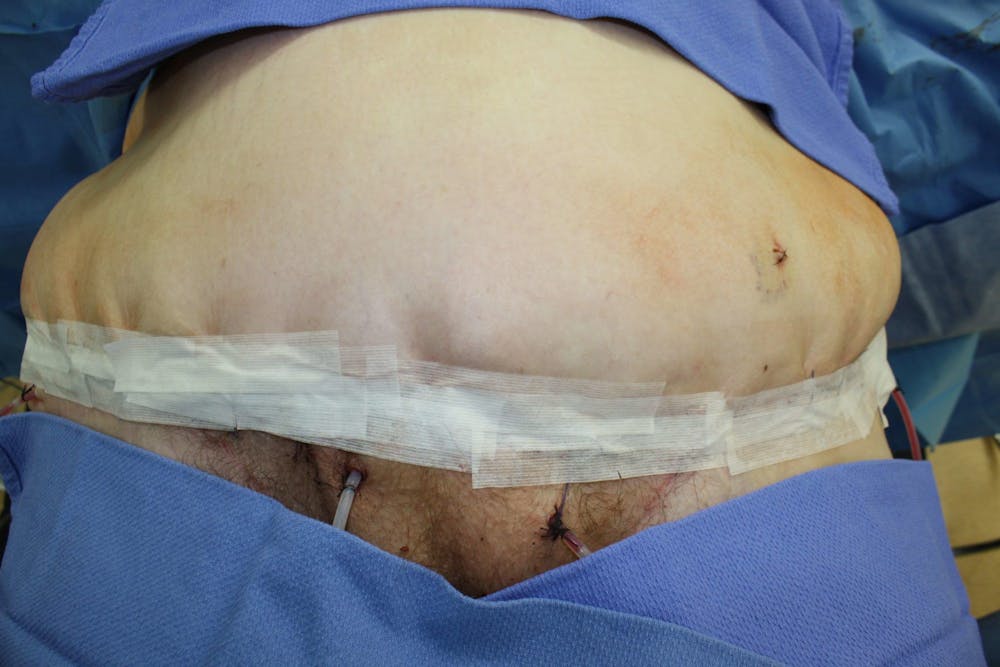 Large Ventral Hernia Repair Before & After Gallery - Patient 5800012 - Image 5