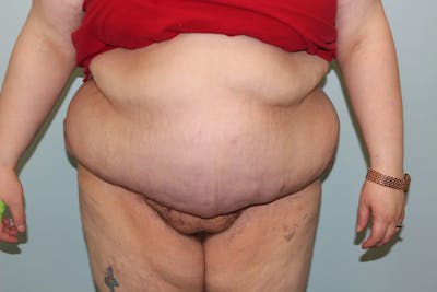 Large Ventral Hernia Repair Before & After Gallery - Patient 5800012 - Image 6