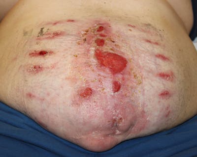 Large Ventral Hernia Repair Before & After Gallery - Patient 5800022 - Image 1