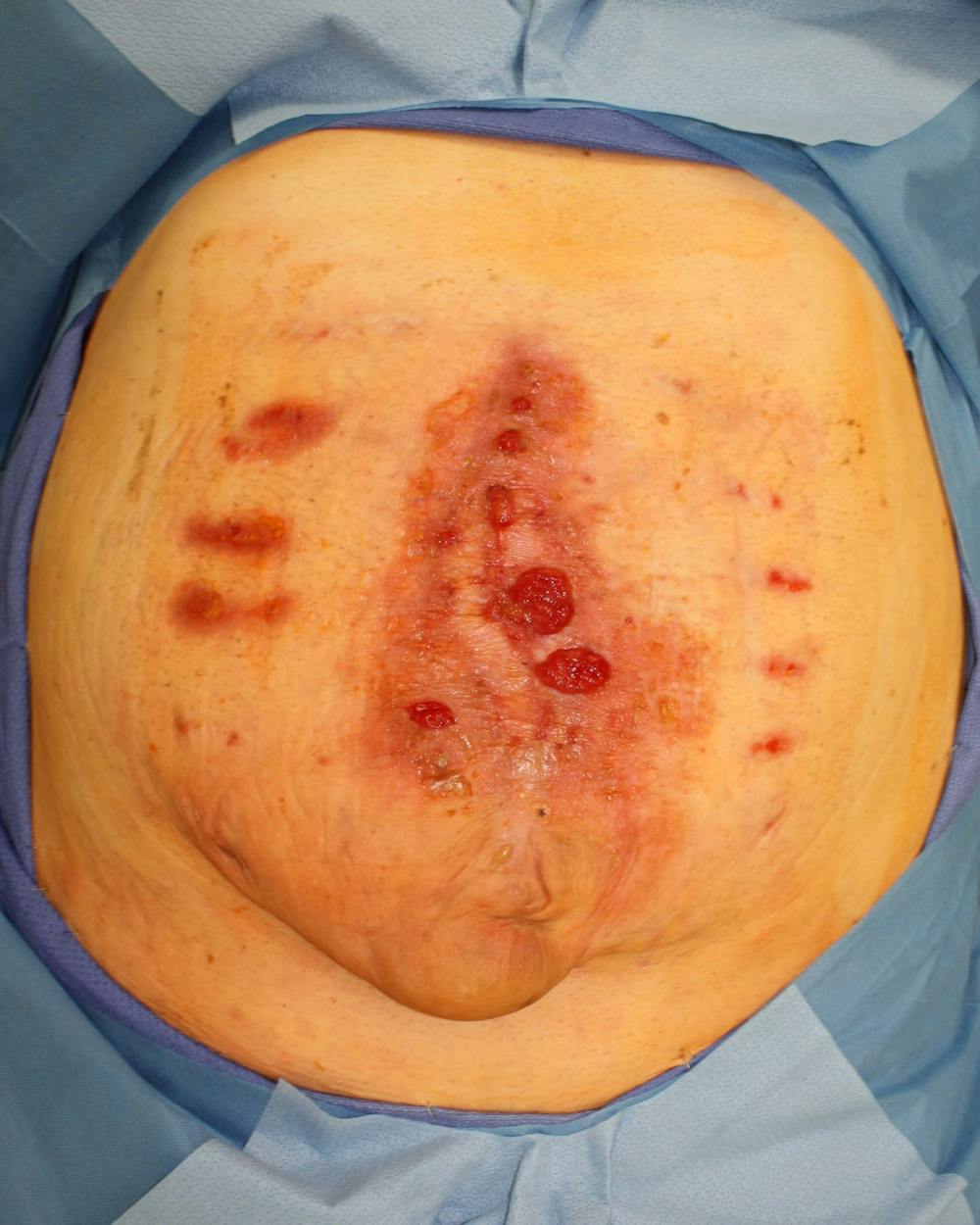 Large Ventral Hernia Repair Before & After Gallery - Patient 5800022 - Image 2