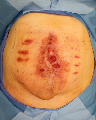 Large Ventral Hernia Repair Before & After Gallery - Patient 5800022 - Image 2