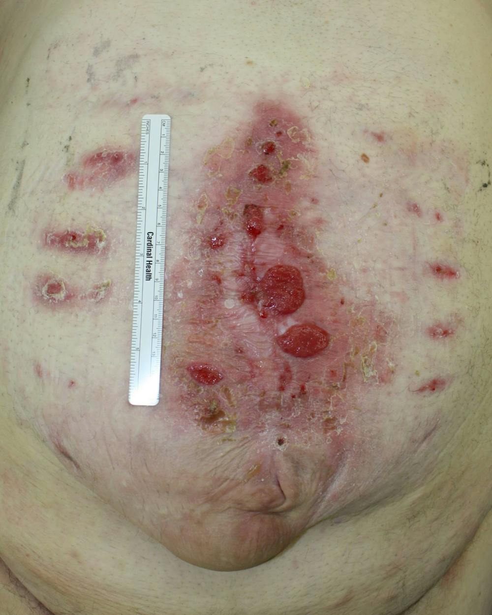 Large Ventral Hernia Repair Before & After Gallery - Patient 5800022 - Image 3