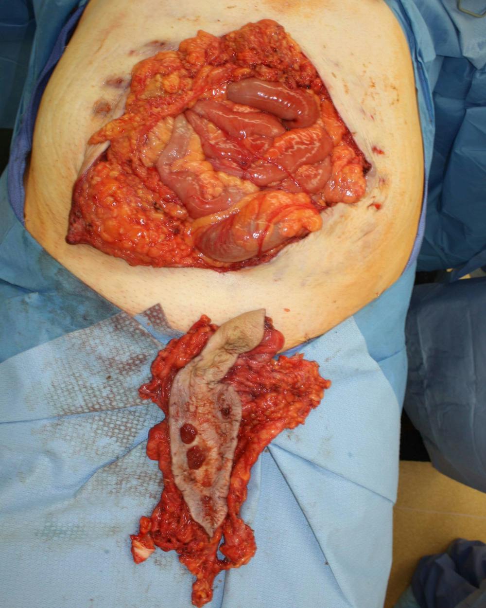 Large Ventral Hernia Repair Before & After Gallery - Patient 5800022 - Image 4