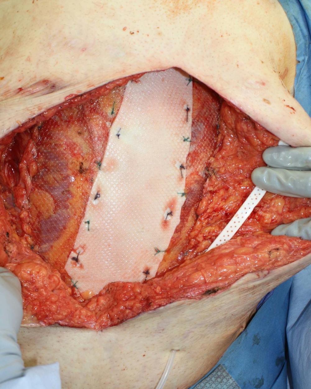 Large Ventral Hernia Repair Before & After Gallery - Patient 5800022 - Image 6