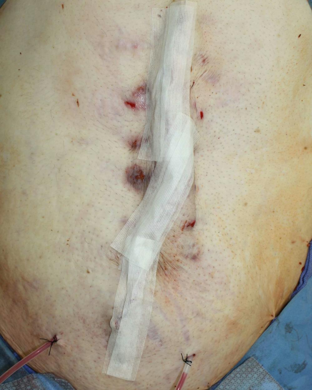 Large Ventral Hernia Repair Before & After Gallery - Patient 5800022 - Image 7
