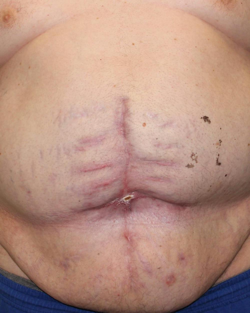 Large Ventral Hernia Repair Before & After Gallery - Patient 5800022 - Image 8