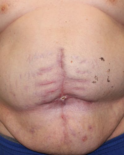 Large Ventral Hernia Repair Before & After Gallery - Patient 5800022 - Image 8