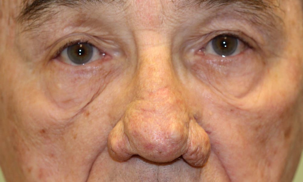 Rhinophyma Surgical Treatment Before & After Gallery - Patient 5800023 - Image 1