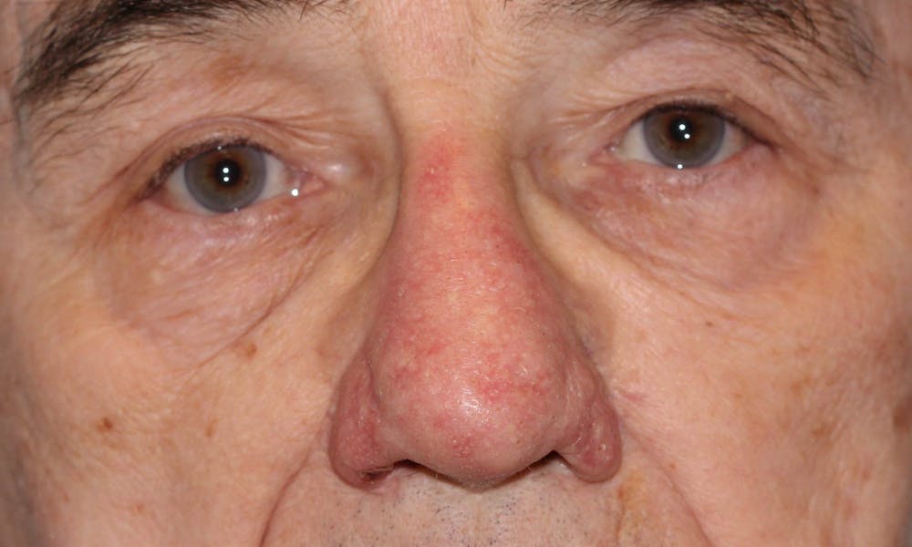 Rhinophyma Surgical Treatment Before & After Gallery - Patient 5800023 - Image 2