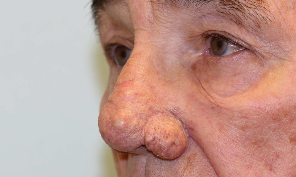 Rhinophyma Surgical Treatment Before & After Gallery - Patient 5800023 - Image 3