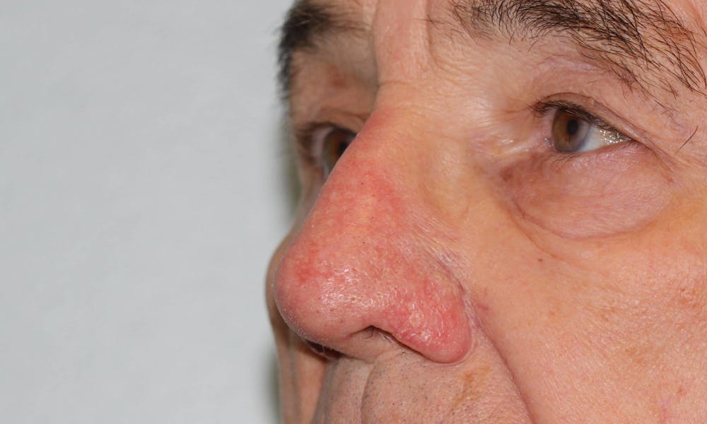 Rhinophyma Surgical Treatment Gallery - Patient 5800023 - Image 4