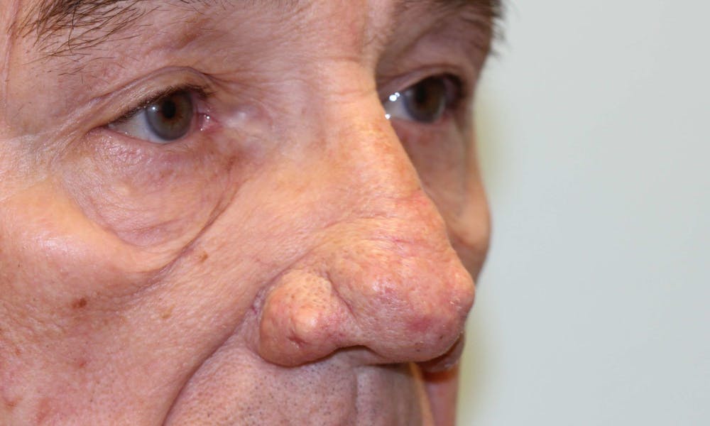 Rhinophyma Surgical Treatment Before & After Gallery - Patient 5800023 - Image 5