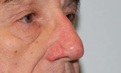 Rhinophyma Surgical Treatment Gallery - Patient 5800023 - Image 6