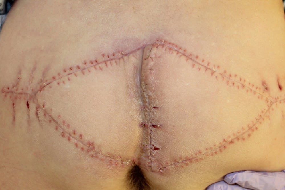 Pressure Sore Reconstruction Before & After Gallery - Patient 5800032 - Image 2