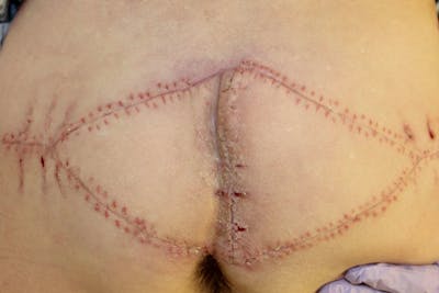 Pressure Sore Reconstruction Before & After Gallery - Patient 5800032 - Image 2
