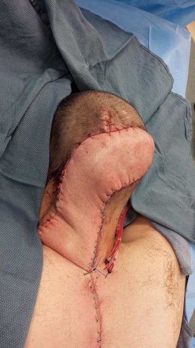 Pressure Sore Reconstruction Before & After Gallery - Patient 5800034 - Image 4