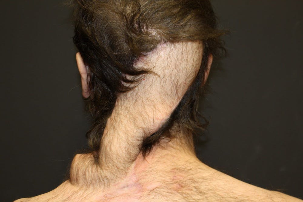 Pressure Sore Reconstruction Before & After Gallery - Patient 5800034 - Image 6