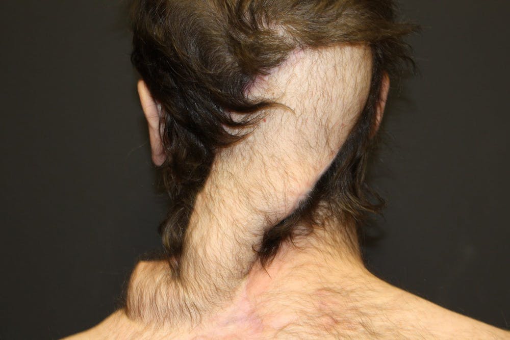 Pressure Sore Reconstruction Before & After Gallery - Patient 5800034 - Image 8