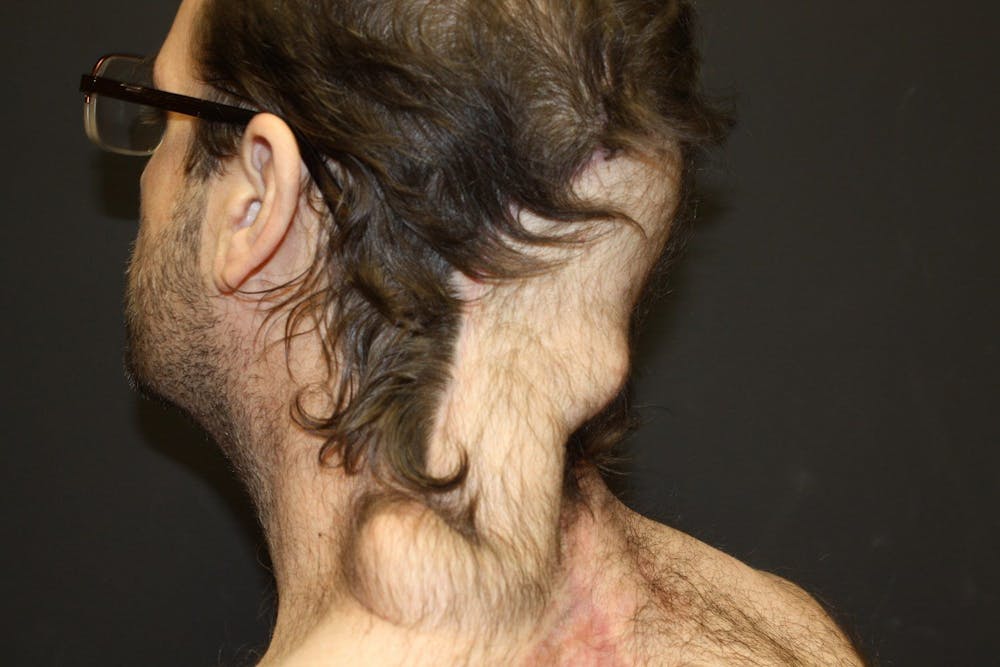 Pressure Sore Reconstruction Before & After Gallery - Patient 5800034 - Image 9